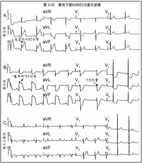 图文详解:心肌缺血和梗死的心电图
