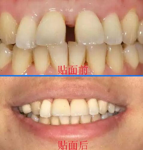 门牙有缝怎么办,瓷贴面帮你修复
