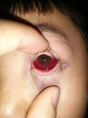 不揉眼睛 眼睛上的血管极为脆弱,外力容易导致出血. 3.