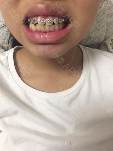中间门牙的缝隙已经不见了,门牙和旁边的牙不再紧紧的挤在一起