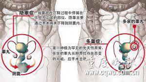 男子做完睾丸切除术22年后发现睾丸仍在(图)
