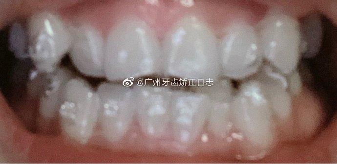 广州牙齿矫正##门牙有缝##时代天使